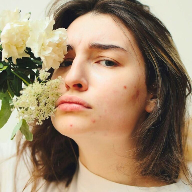 Not Sure Why You’re Breaking Out? Here Are 12 Most Common Causes Of Acne