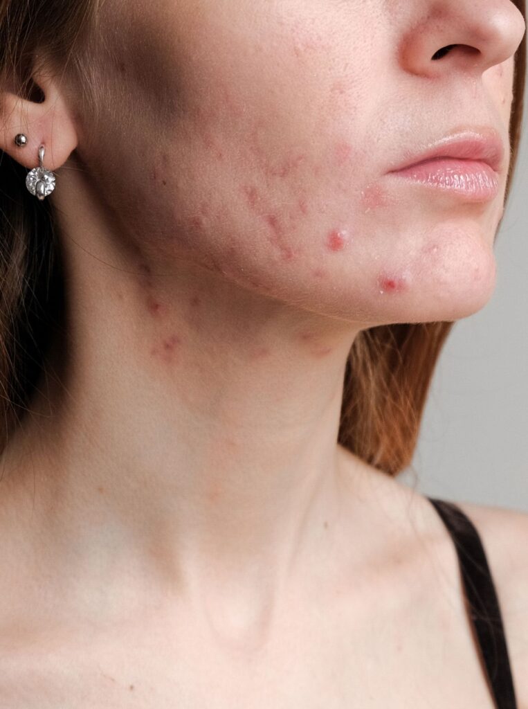 woman with hormonal acne