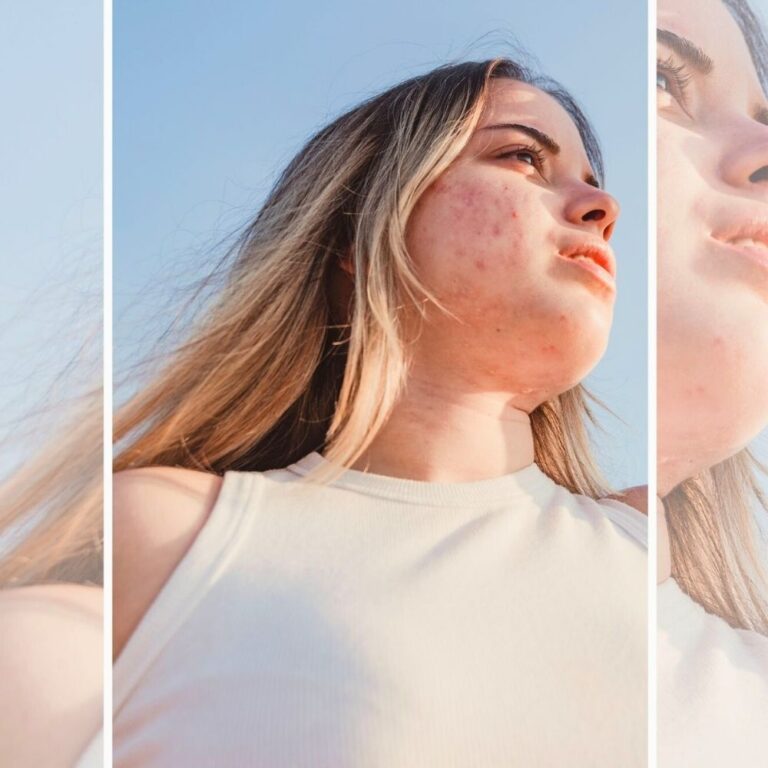 How To Get Rid of Acne Scars and Clear Up Your Skin For Real